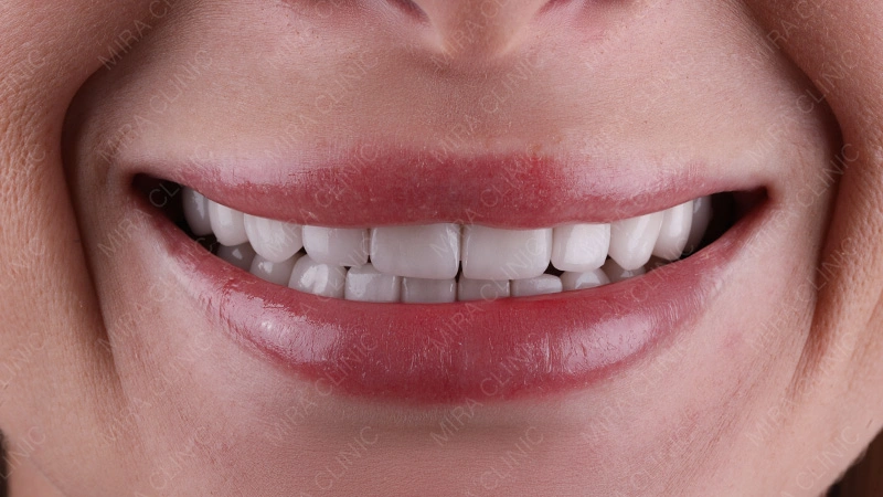 Natural Teeth After Veneers